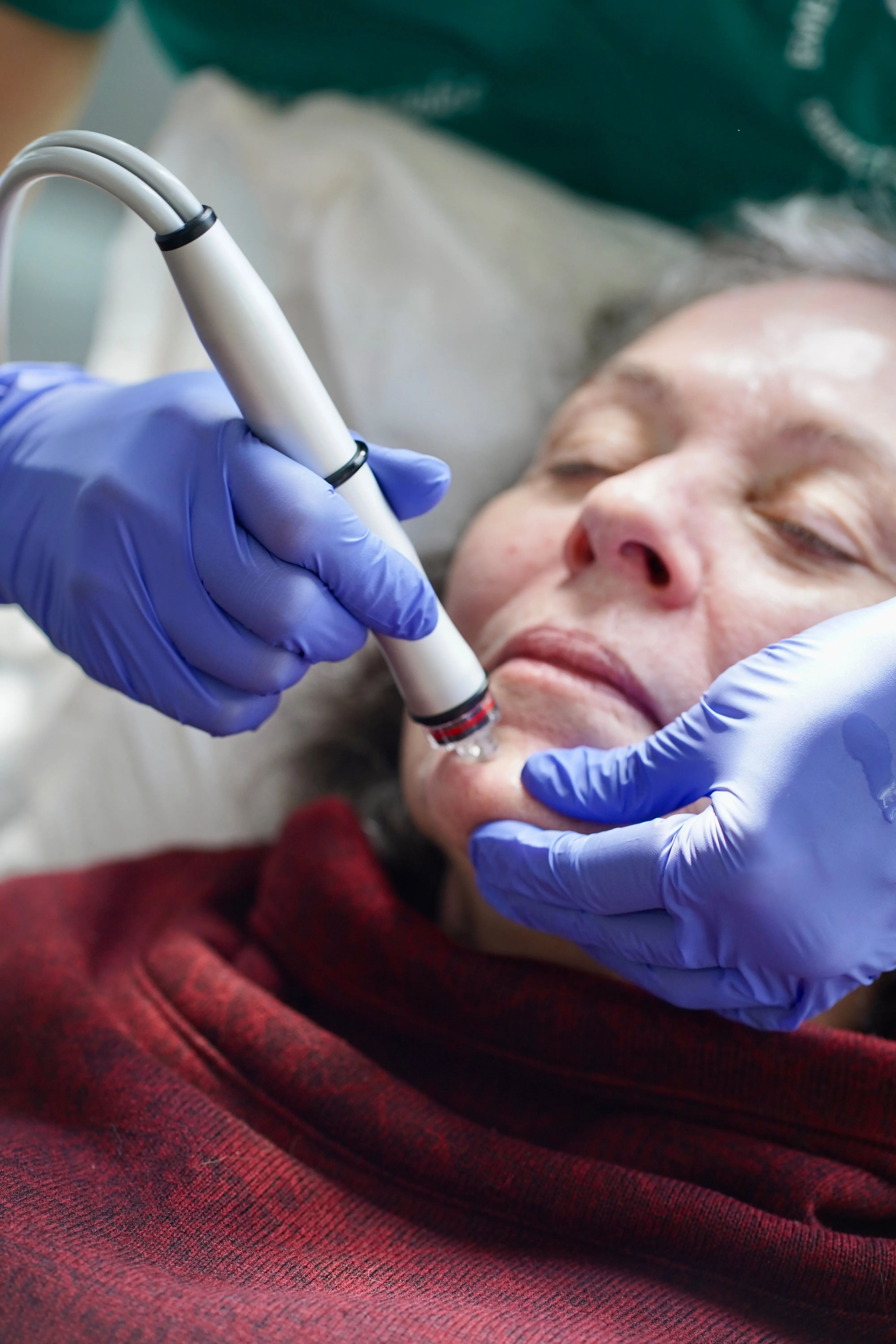 Cytopeel Hydrofacial